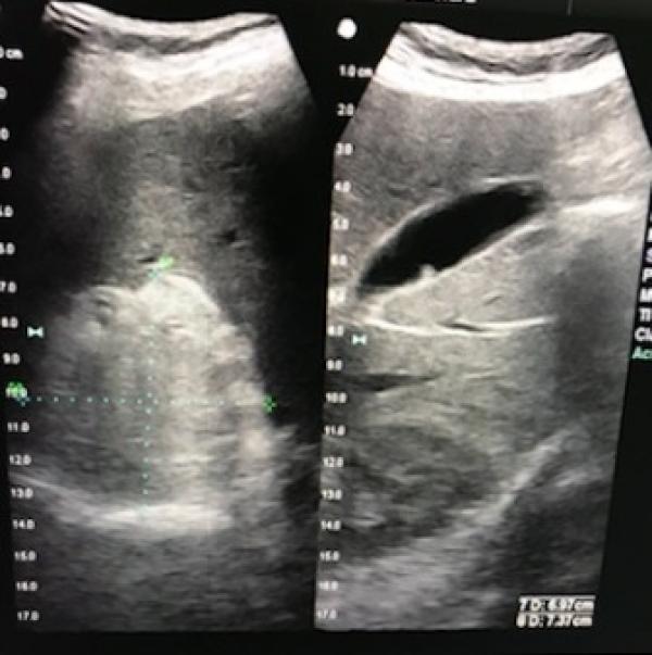 Tumor Mielolipoma de la glándula suprarrenal derecha